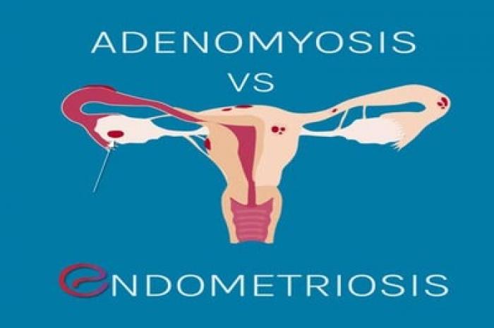 What Is Adenomyosis and How Is It Different From Endometriosis?